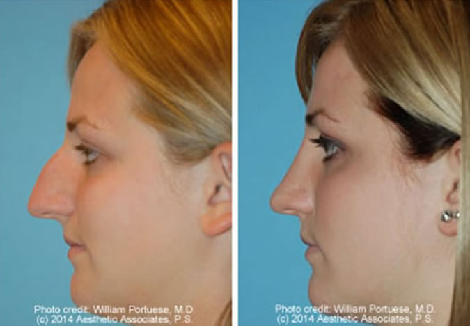 Rhinoplasty Anchorage AK