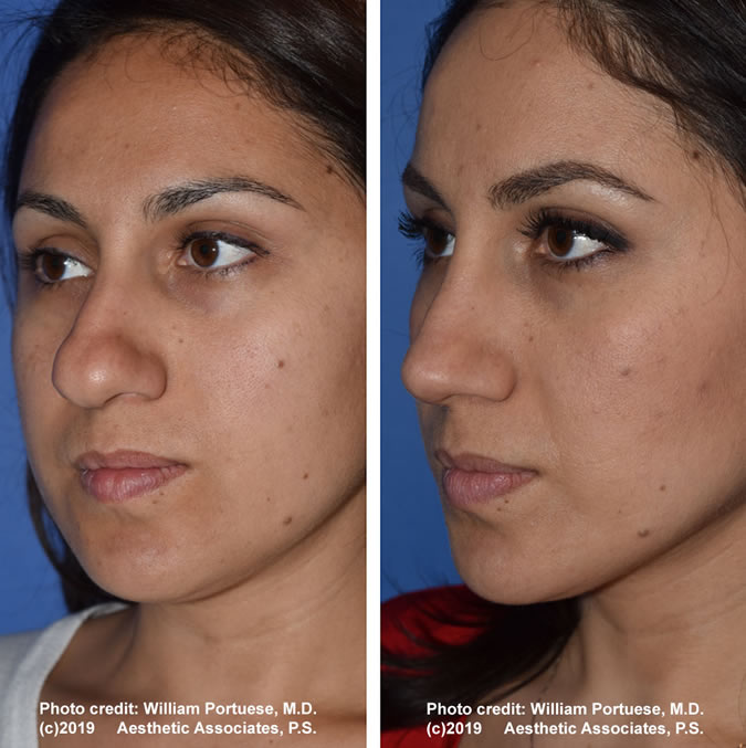 Rhinoplasty Recovery