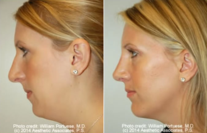 Rhinoplasty Cost