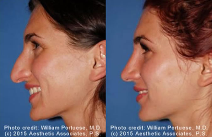 Rhinoplasty Cost